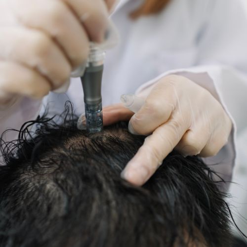 A man receiving hair loss treatment